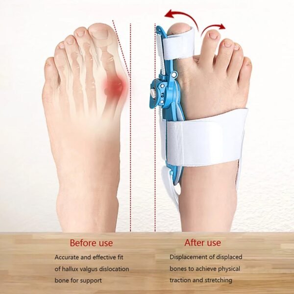 Adjustable Bunion Support Splint ? Hallux Valgus Corrector for Men & Women - Image 5