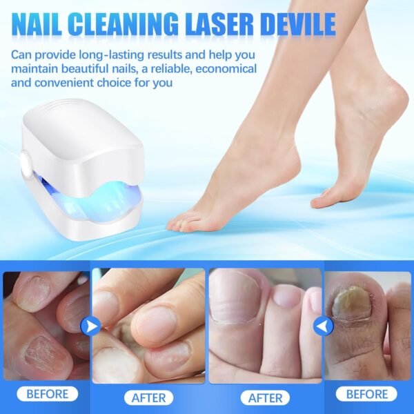 Rechargeable Nail Fungus Laser ? Anti-Fungal Device for Toenails, Hands & Feet - Image 5
